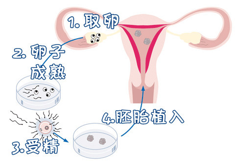 关于试管代孕包成功男孩